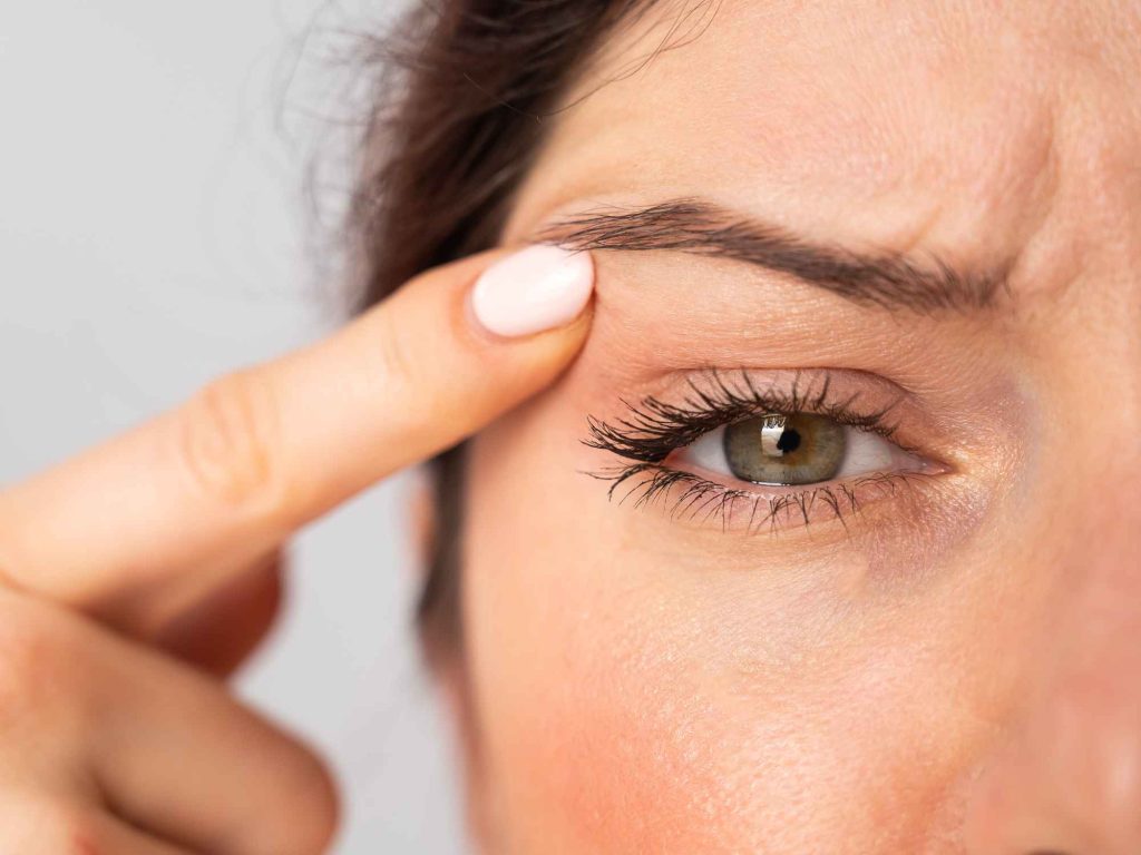 Upper eyelid surgery by Kliniek het Bolwerk