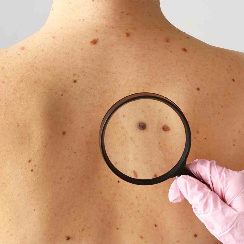 Removal of nevi