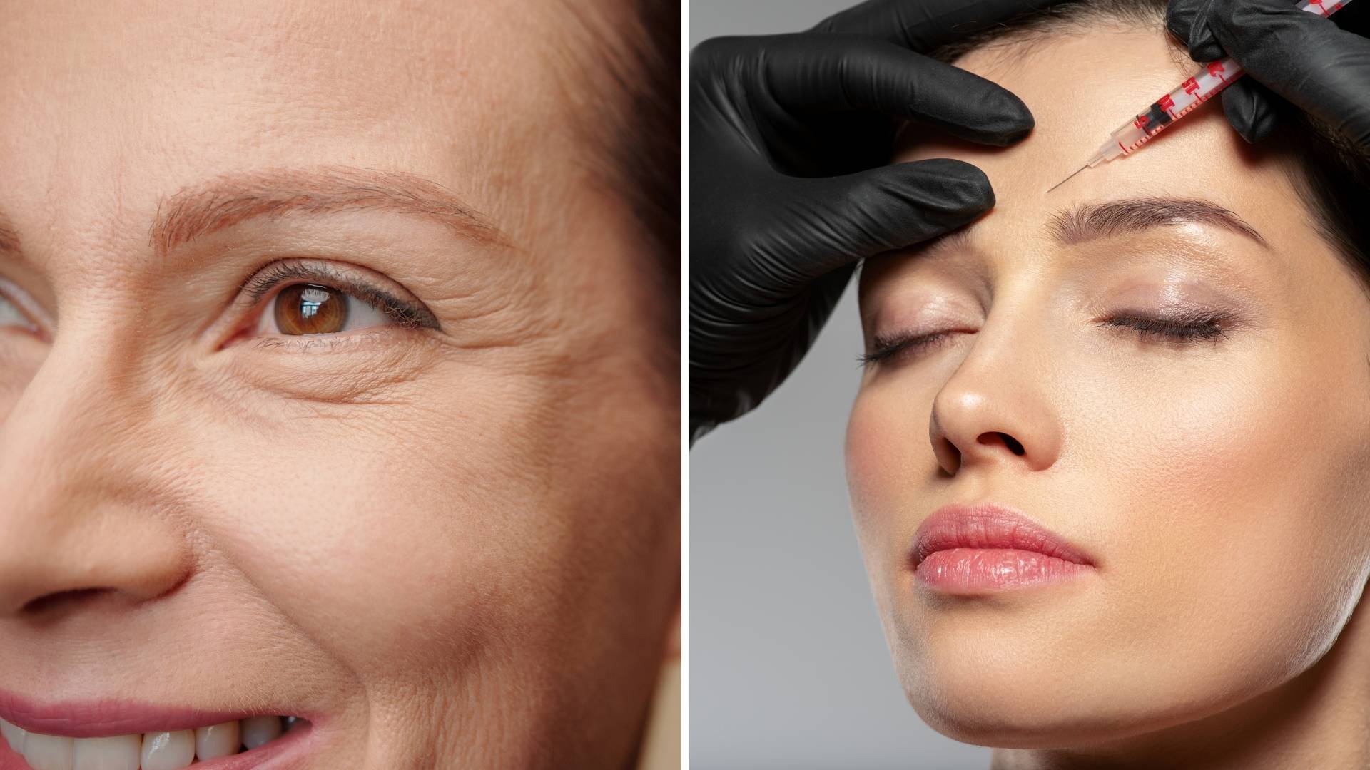This is how botox works on wrinkles in the skin