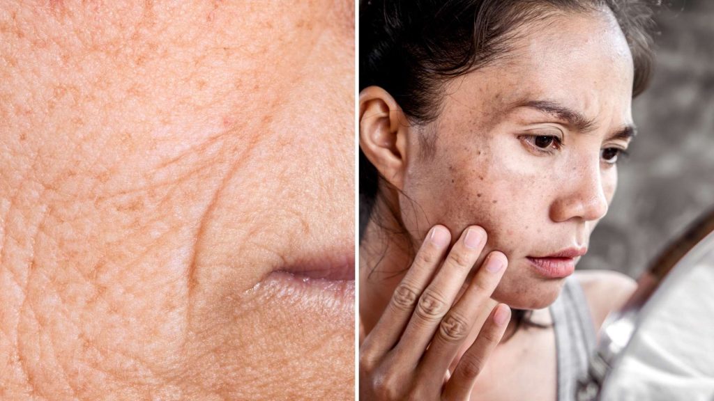 What causes wrinkles Botox