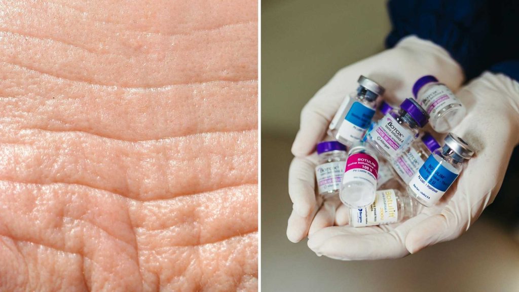 Botox en voorhoofdsrimpels