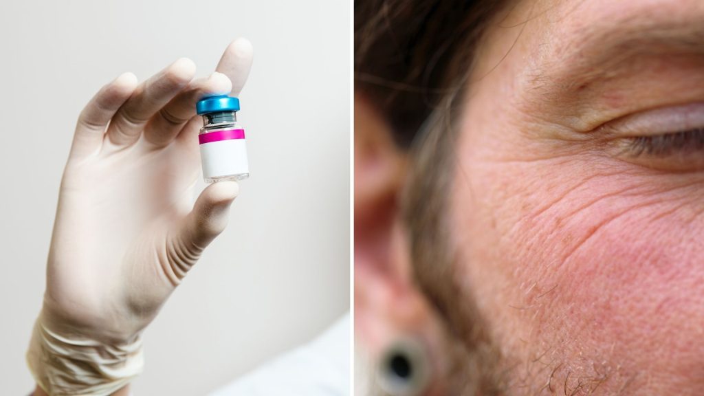 How Botox works on crow's feet