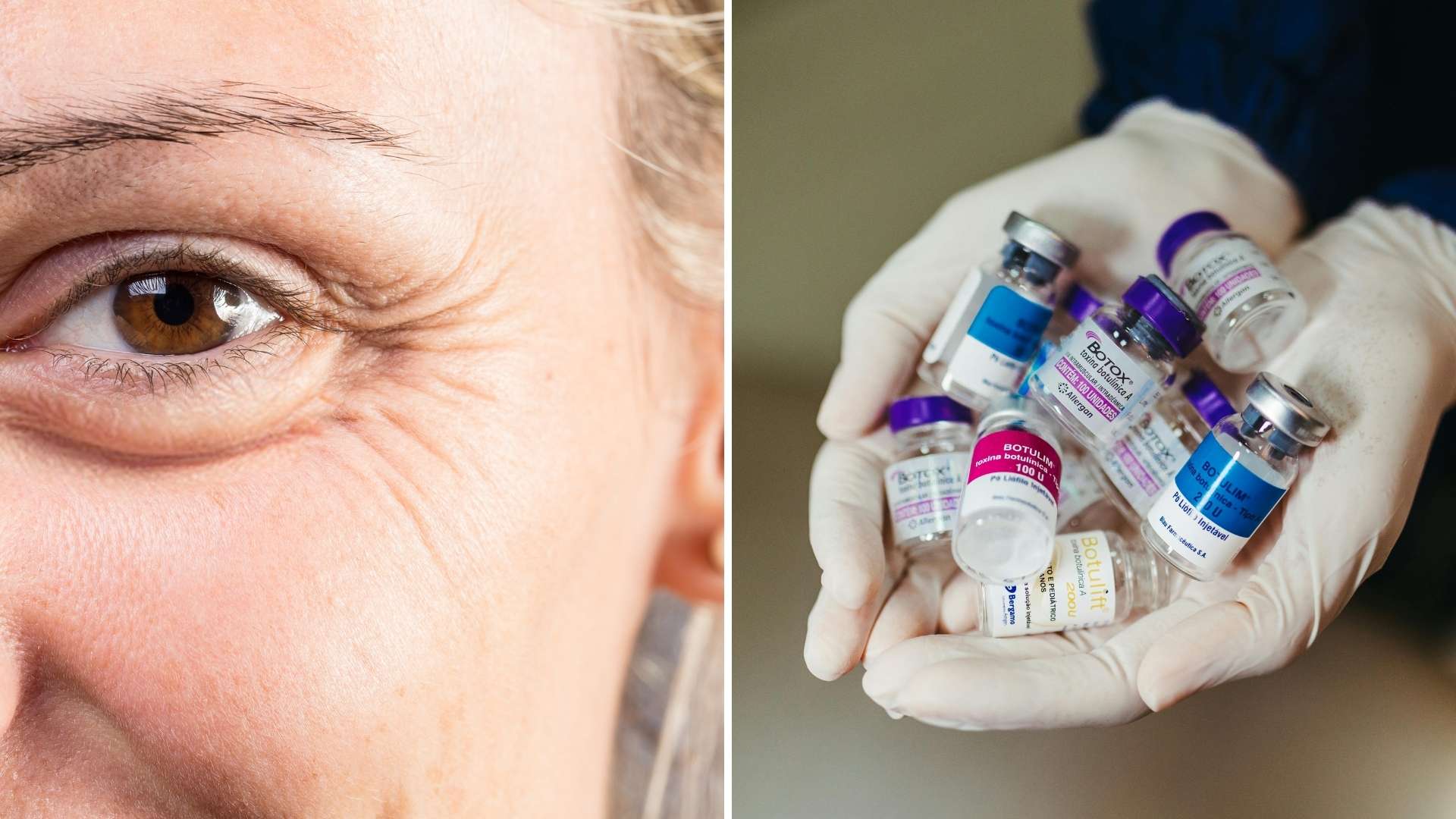 What botox does for crow's feet