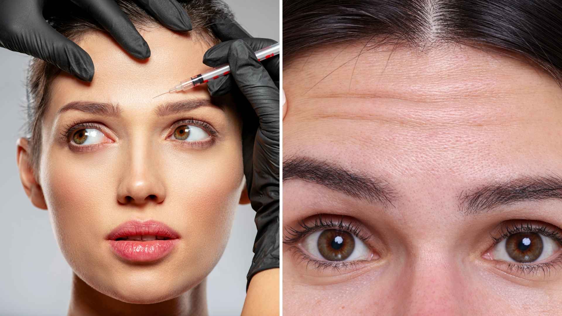What botox does for forehead lines