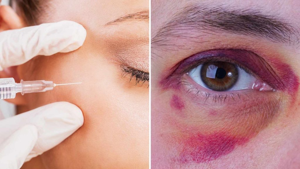 What to do about bruising after injectables&nbsp;
