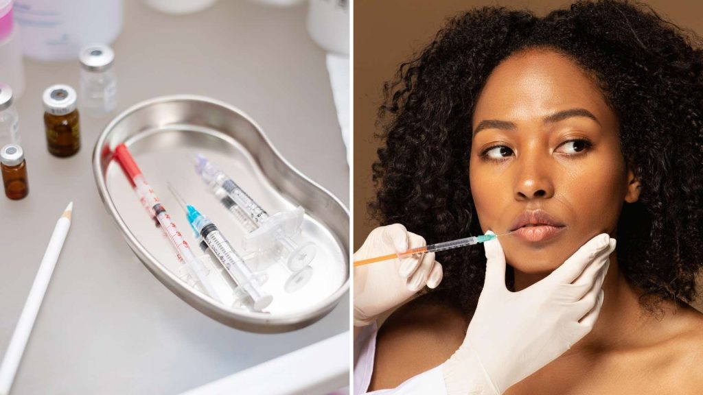 Recovery after fillers: a few days after treatment