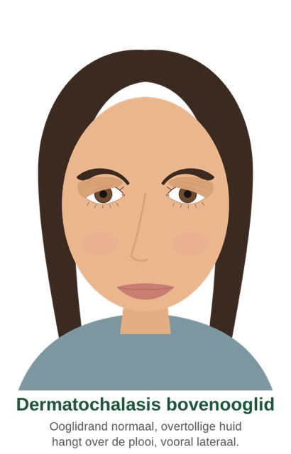 Dermatochalasis of the upper eyelid: excess skin hangs over the eyelid crease