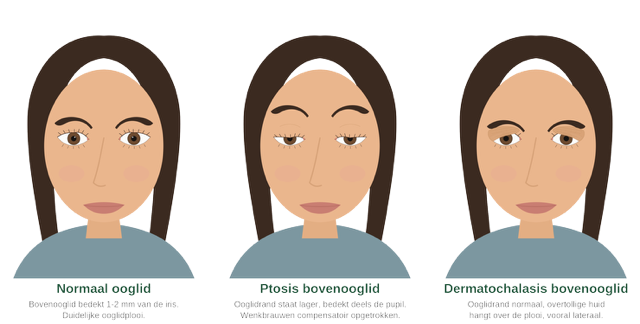 Comparison of a normal upper eyelid, ptosis and dermatochalasis