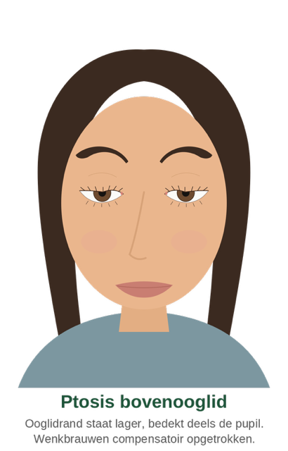 Ptosis of the upper eyelid: the eyelid margin sits lower and partly covers the pupil